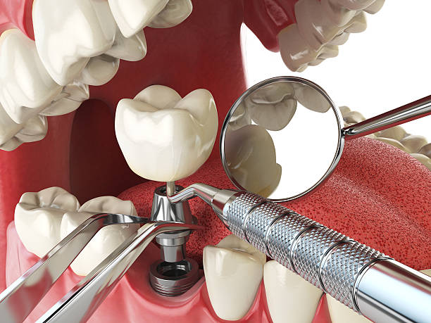 Best Knocked-Out Tooth (Avulsed Tooth) Treatment in Brownsville, PA